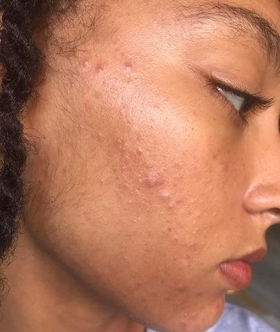 How to Treat Acne in Nigeria